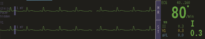 monitor-EKG
